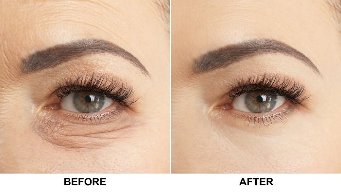 BLEPHAROPLASTY